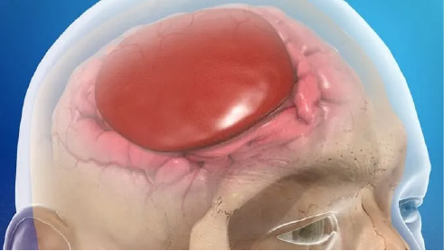 Hematomas Subdurales Crónicos