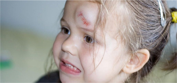 Trauma craneoencefálico